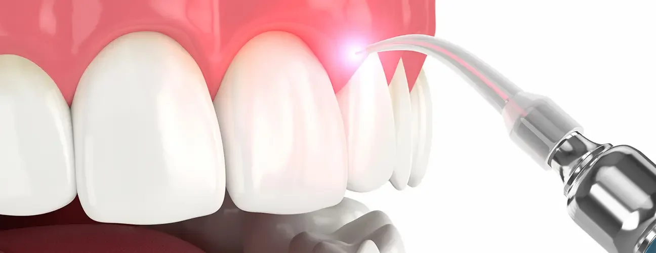 Laser Depigmentation