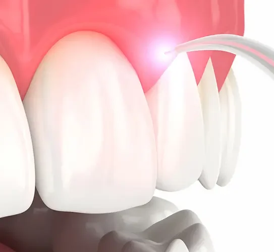 Laser Depigmentation