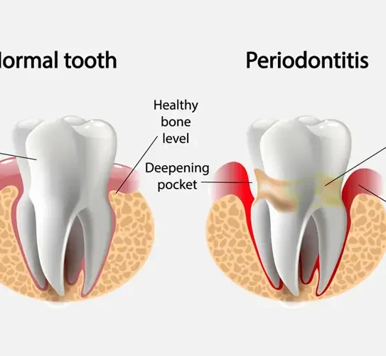 Periodontal Maintenance